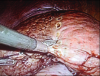 Laparoscopic S4 segmentectomy
