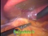 laparoscopic right adrenalectomy