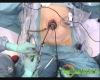 Gist resection