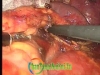 laparoscopic left adrenalectomy