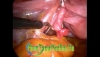 laparoscopic total hysterectomy